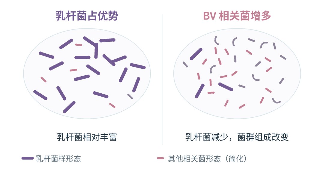 细菌性阴道病BV乳杆菌减少与厌氧菌增殖的阴道微生态变化