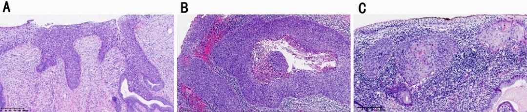 北京大学人民医院魏丽惠教授团队发表于《Clinical Epigenetics》的前瞻性回顾研究，通过HPV病毒载量与PAX1/JAM3双基因甲基化两大分子标志物，对这一特殊类型宫颈癌进行了探索，为临床精准诊断提供全新分子依据。