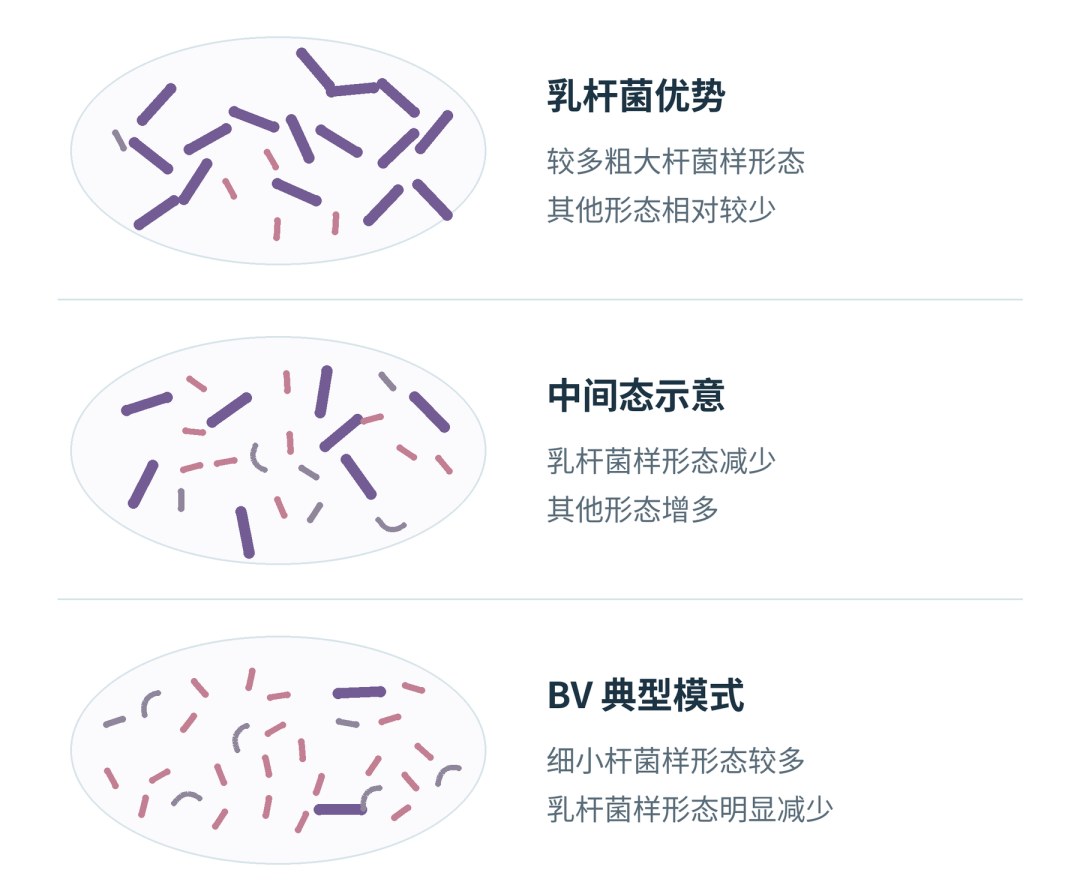 革兰染色用于BV阴道菌群形态与结构评估